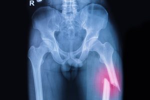 Osteoporosis medications can cause small risk of thigh bone fractures: Study 