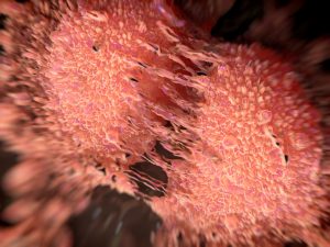 Prostate cancer patients on active surveillance may have metastasis
