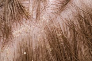 Psoriasis influenced by stress, linked to itchy skin, hyperhidrosis, and flaky patches on scalp