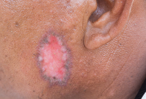 Psoriasis vs. ringworm, differen...