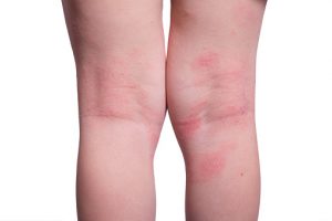 Shingles vs. eczema