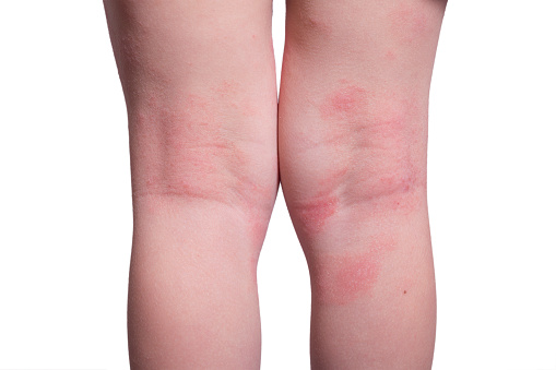Shingles vs. eczema, differences...