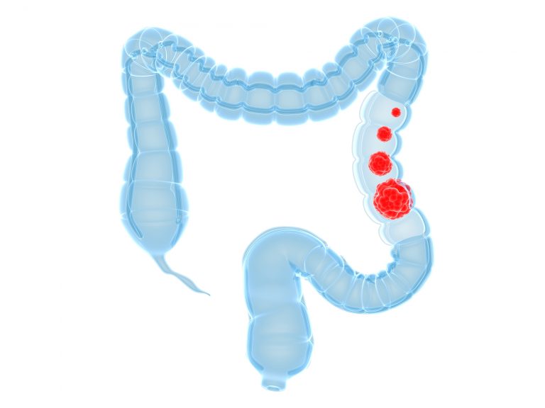 Ulcerative colitis and colon cancer risk linked to certain proteins and ...