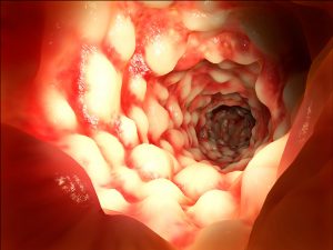 In ulcerative colitis, patients more concerned about IBD complications than treatment side effects