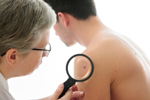 Vitiligo may predict immunothera...