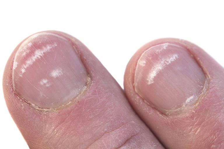 What Causes White Spots on Nails (Leukonychia)?