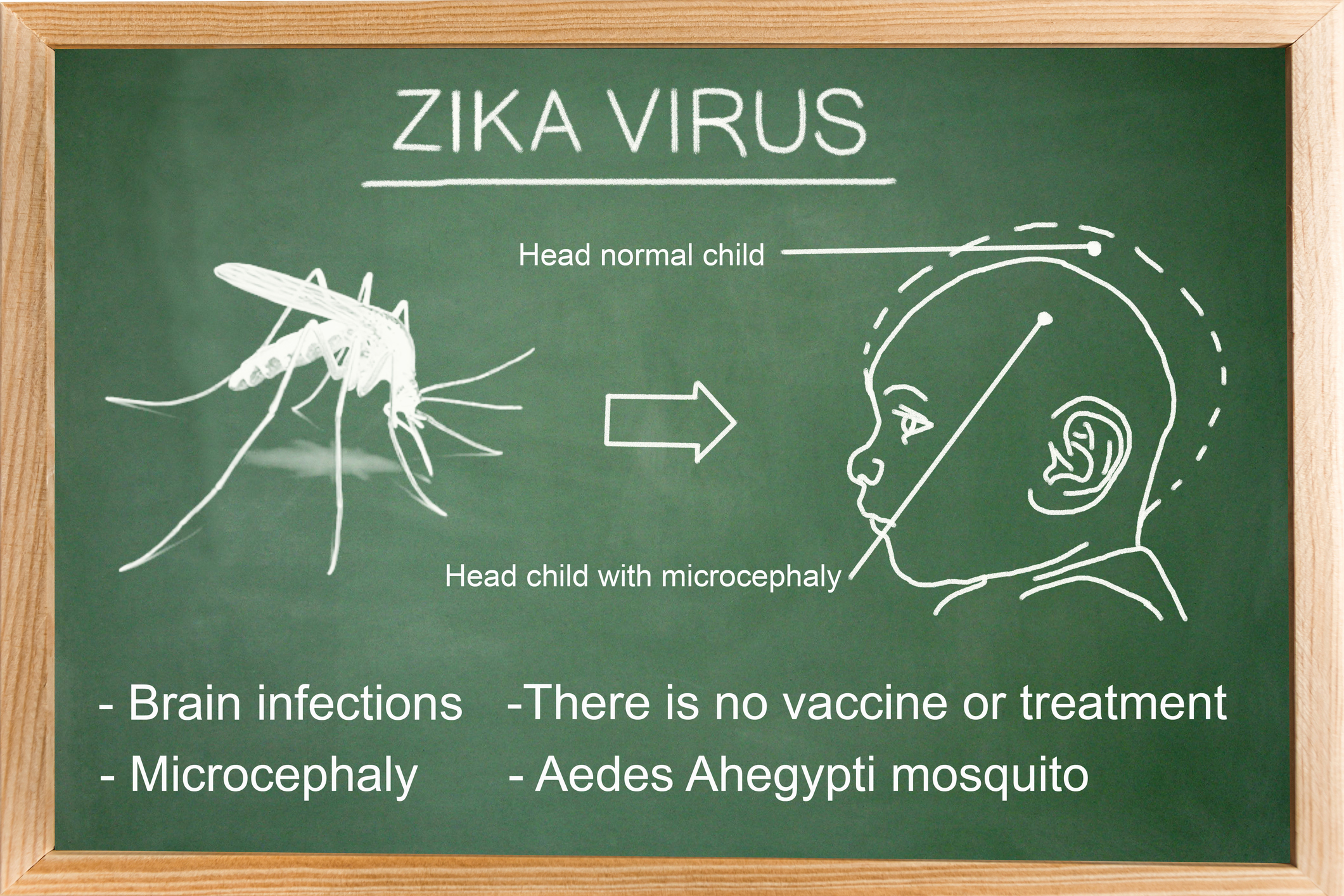 Baby born with Zika defect in Ne...
