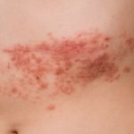 Shingles risk can increase with inflammatory bowel disease