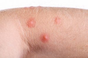 Flea bites vs. bed bug bites, difference in symptoms and treatments