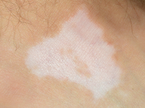 Can gluten-free diet cure vitiligo?