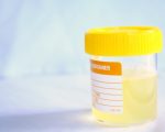 Cloudy urine: Causes, symptoms, and treatments