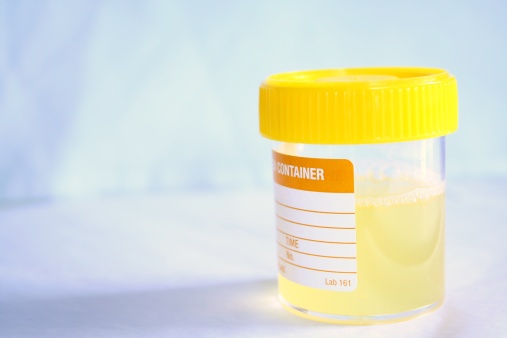Cloudy urine: Causes, symptoms, ...