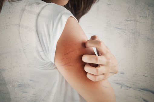 Eczema effects span beyond the s...