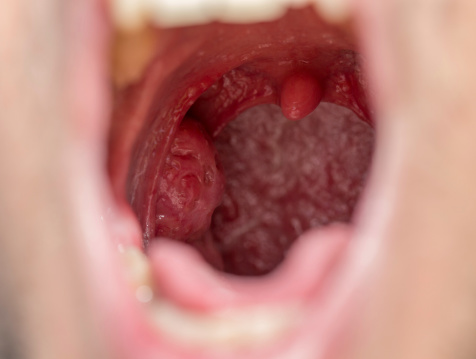 Enlarged uvula can lead to snori...