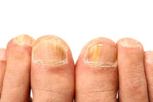 how long is ringworm contagious fungus foot