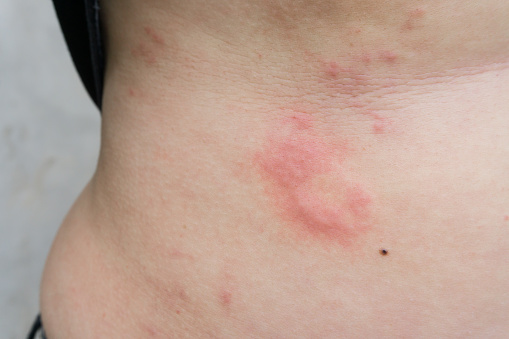 How to get rid of hives naturally?