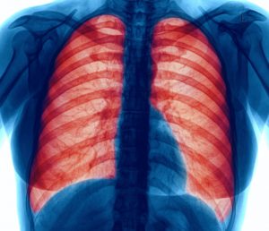 In COPD patients, pneumonia survival in hospitals improved with inhaled corticosteroids: Study