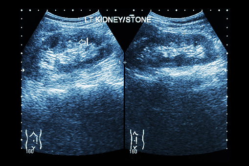 Noninvasive kidney stone ultraso...
