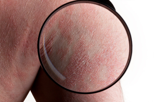 Psoriasis severity may be influe...