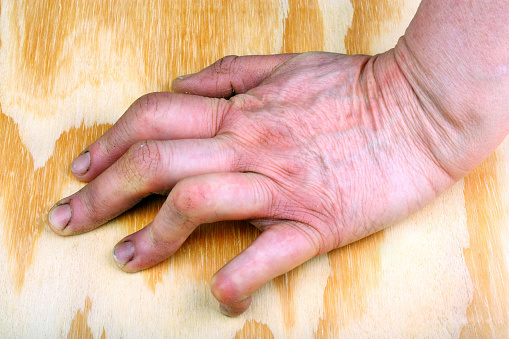 Rheumatoid arthritis vs. lupus: ...