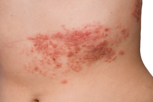 Shingles risk can increase with ...