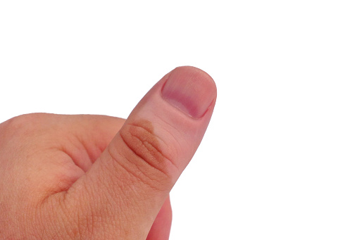 In vitiligo, skin transplant sur...