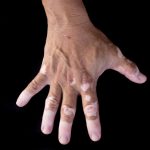 vitiligo skin dispigmentation