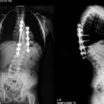 Scoliosis, an abnormal spine curvature in adolescence, may also affect older adults