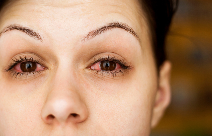 Allergic conjunctivitis causes, ...