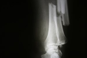 Bone health not improved after weight loss surgery