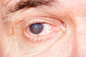 Cataracts update 2016: Alzheimer...