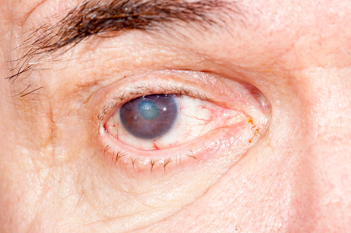 Cataract risk increases with chr...