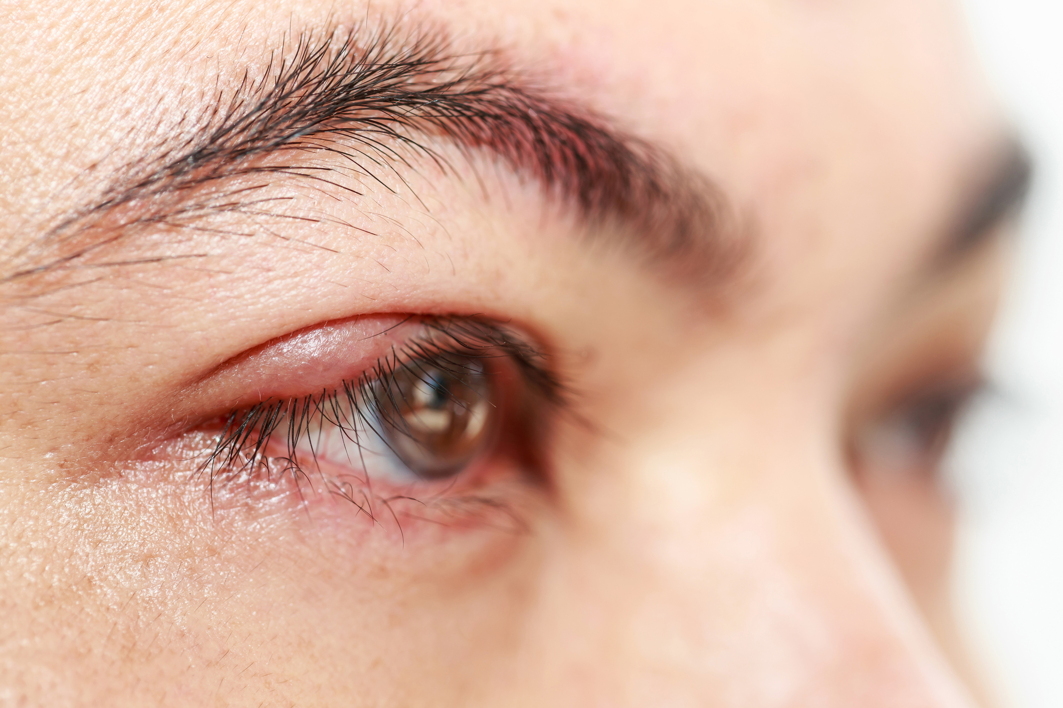 Chalazion (lump in the upper or ...