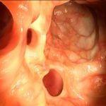 Diverticulitis patients reveal psychological, physical symptoms long after their acute illness has passed: Study