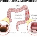 New irritable bowel syndrome (IBS) symptoms seen after acute bout of diverticulitis