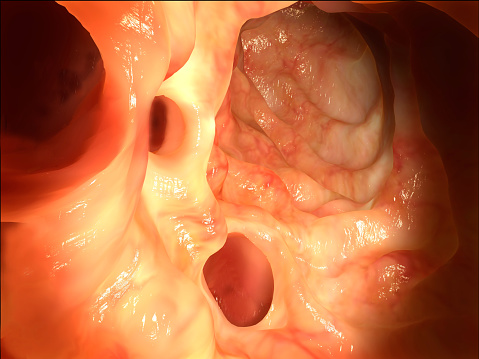 Diverticulitis patients reveal p...