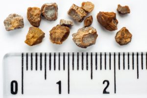 Infections from kidney stones and other urinary tract obstructions twice as common in women: Study