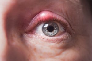Is a stye contagious?