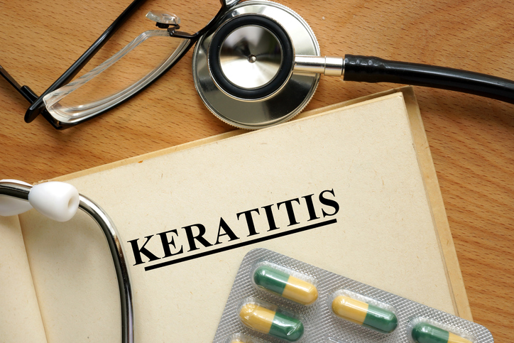 Keratitis (inflammation of the c...