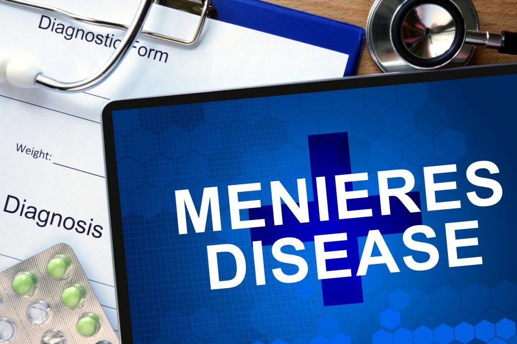 Meniere’s disease caused by fluid buildup in inner ear and vascular
