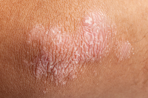 Treating psoriasis reduces risk ...
