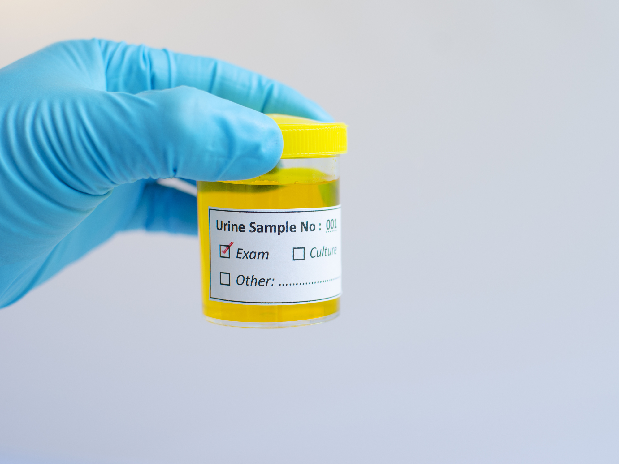 Urethritis (inflammation of the ...