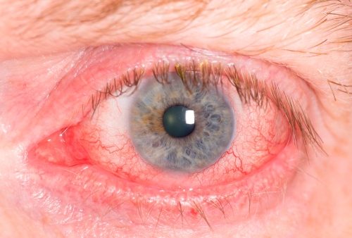 Uveitis Causes Symptoms And Treatment