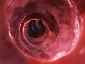 Diverticulitis, gallstones, chronic kidney disease, glaucoma, and IBS