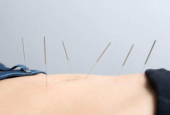 Acupuncture may offer relief for...