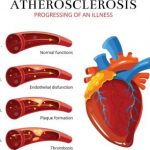 Atherosclerosis prevention: natural home remedies, diet, and exercise