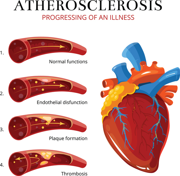 Atherosclerosis Prevention: Natu...