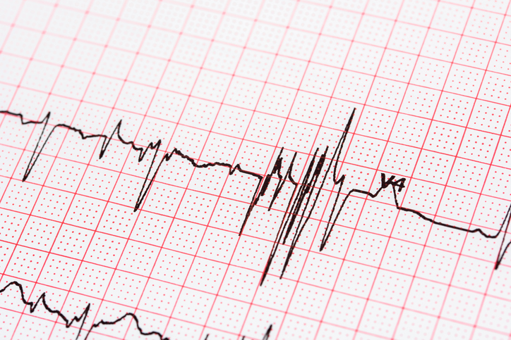 Weekly health news: Atrial fibri...