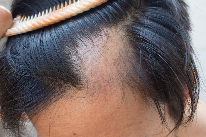 Certain types of hair loss may b...