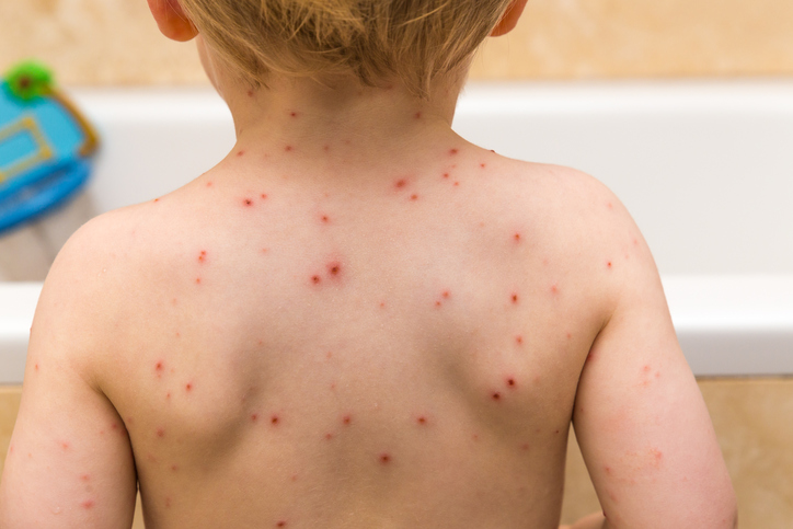 Chickenpox cases down 85 percent...